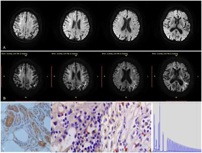 Retrospective review of bladder biopsy instead of skin biopsy provided clue for the diagnosis of neuronal intranuclear inclusion disease